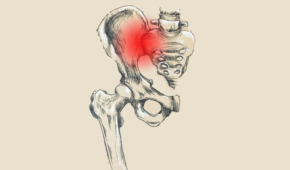 sacroileítis y osteopatía